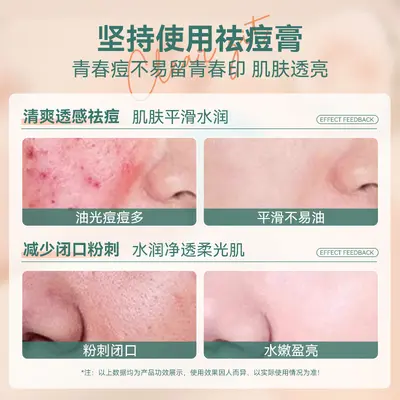 Mingxizhi Acne Cream, Refreshing and Moisturizing, for Teens and Students - 5
