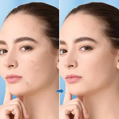 Acne Patch, Gentle Blackhead and Acne Mark Reducer, Skin Balancing - 5