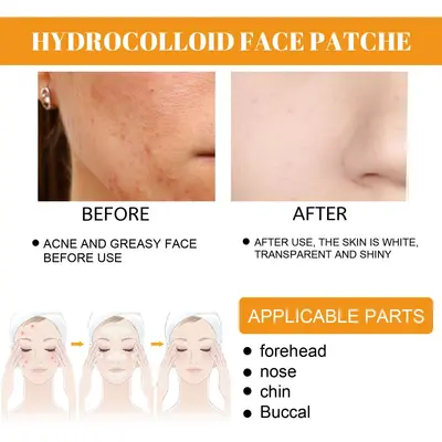 EELHOE hydrogel acne patch, portable, invisible