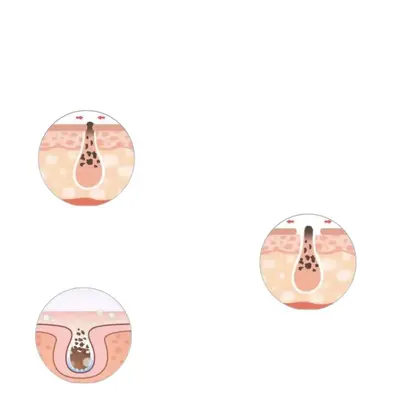 Blackhead Removing Nose Mask Strip, Moisturizing Pore Cleansing Face Mask Cream - 5