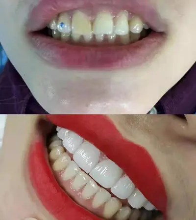 全瓷美牙贴面 牙齿贴片全瓷贴片私人美牙贴冰瓷蓝瓷琥珀瓷贴片