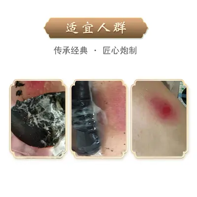 厂家批发提毒贴拔脓贴 红包硬块疙瘩火疖子提毒拔脓贴拔脓膏