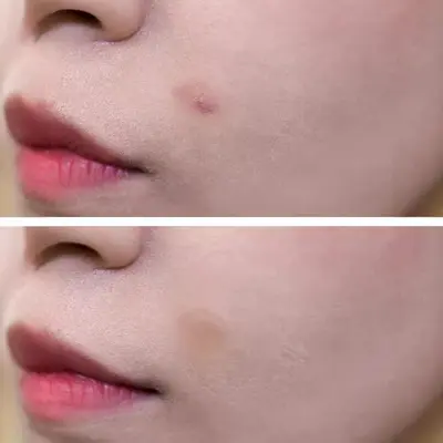 Корейские патчи от прыщей VT Acne Patch Tiger Patch невидимые прозрачные для мужчин и женщин, студентов, осветляют следы acne, закрытые комедоны, 18 штук, китайский стандарт - 5