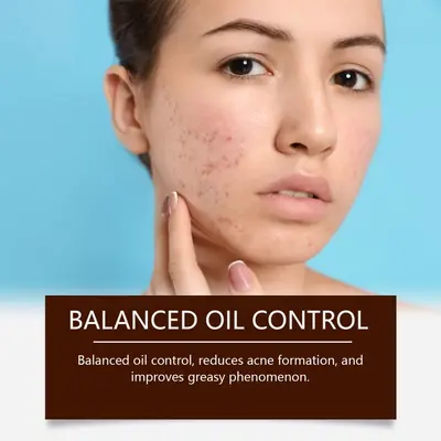 OUHOE Herbal Acne Cream, Gentle Moisturizing Facial Care - 3