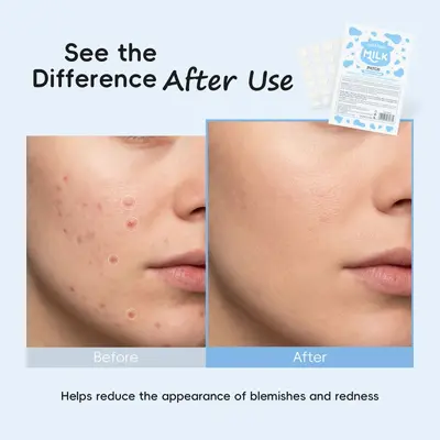 跨境LAIKOU牛奶痘痘贴24块/片 COVER PIMPLE PATCH 外贸全英文