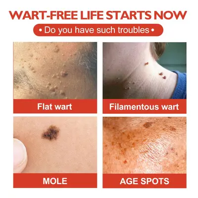 OUHOE Acne Patches, Skin Clearing, for Warts and Corns - 3