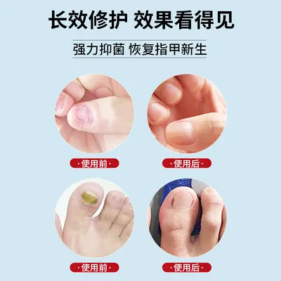 Gray nail pen, gray nail antibacterial gel, nail protection and care all in one, no need to remove nails, nail repair, wholesale and distribution.