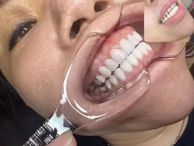 美牙全瓷贴片团队学习瓷片材料牙贴美牙玻璃瓷牙齿贴面牙齿美白 - 3