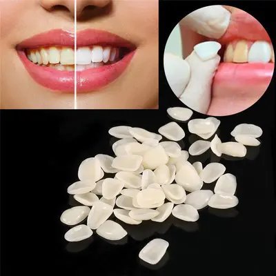 Zahnveneers A1 A2, provisorische Zahnschalen - 3