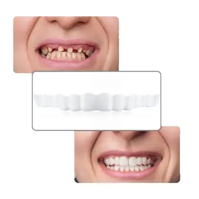 Realistic Upper and Lower Dental Veneers, Gen 2 Temporary Smile Covers - 6