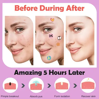 Colorful Envelope Box Pimple Patches, 5 Pieces per Pack - 3
