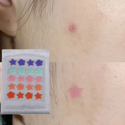Multicolor Invisible Hydrocolloid Pimple Patch, Transparent, Under Makeup
