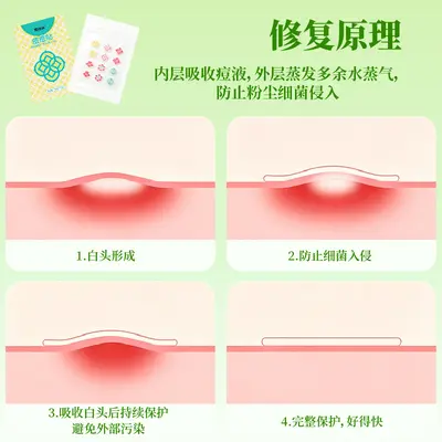 Hydrocolloid Acne Patch, Dunhuang Co-Branded, Cosmetic Registered - 4
