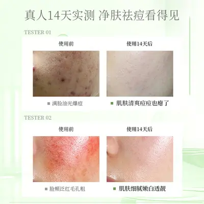 Anti-Acne Serum, Fades Acne Marks, for Teens - 4