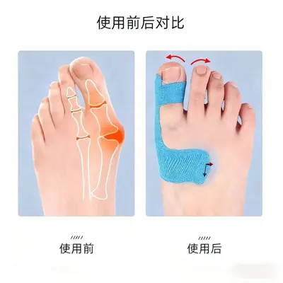 Vorgefertigte Muskelschmerz-Tape für Hallux-Valgus-Korrektur, elastisches Kinesiologie-Tape, rutschfest, Fixierung und Unterstützung, blasenfrei, Schutz - 3