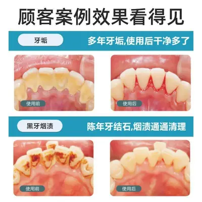 跨境便携冲牙器洗牙器去牙结石家用智能识别保护牙龈超声波洗牙仪