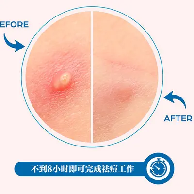 微针可溶无创痘痘贴舒缓贴片式微晶导入加速吸收日用通用祛痘印