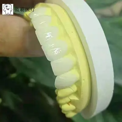 全瓷美牙贴面 牙齿贴片全瓷贴片私人美牙贴冰瓷蓝瓷琥珀瓷贴片