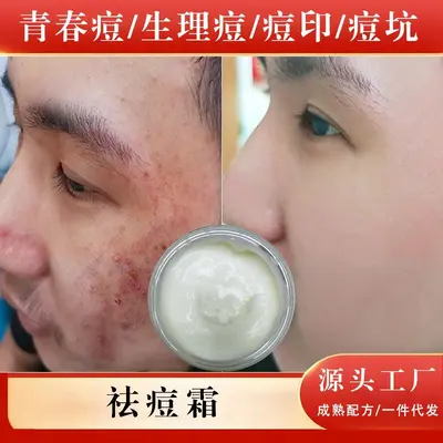 草本高端祛痘膏去青春痘粉刺闭口男女通用温和淡化痘印痘坑祛痘霜