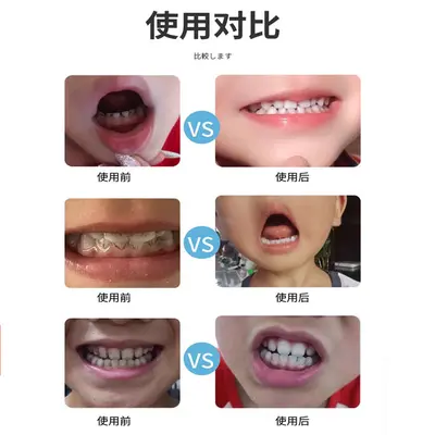 KINBATA Japon diş temizleme diş güzellik fırçası çay lekeleri tartar kalıp noktaları parlak diş silgi - 3