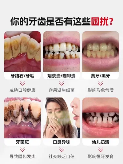 超声波洁牙器牙结石去除器冲牙清洁牙齿结石污垢洗牙家用神器 - 9