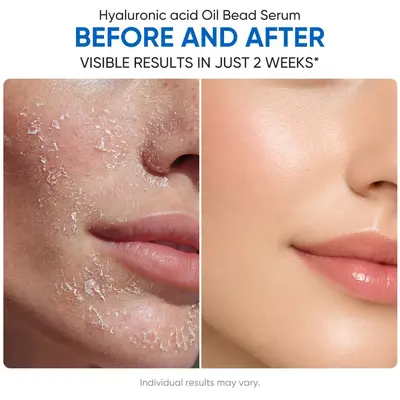 Hyaluronsäure-Öltropfen Serum Barrierenreparatur glättend feuchtigkeitsspendend