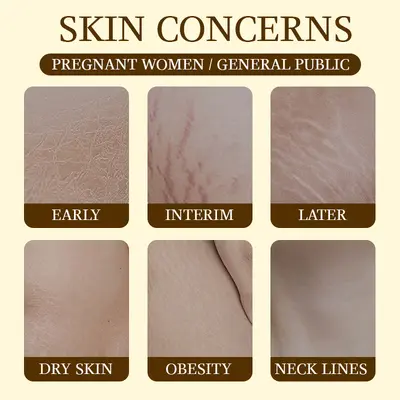 Pregnancy Stretch Mark Oil, Postpartum Stretch Mark Massage Oil - 4