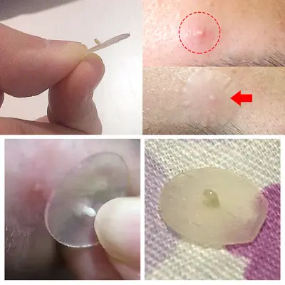 BREYLEE çay ağacı sivilce yaması, gece kullanımı, 0,3 mm ince - 4