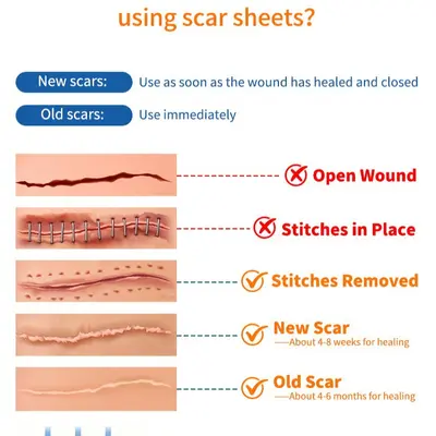 CE FDA Silicone Gel Scar Sheet, Roll Scar Cover Patch - 4