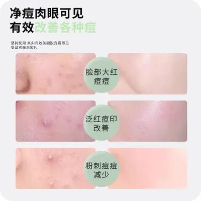 电子痘痘贴物理吸脓温和不刺激体轻薄透气祛斑仪日夜双效祛痘仪