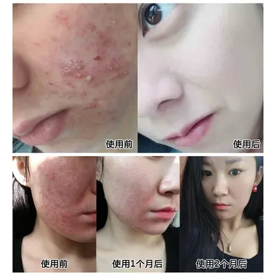 Acne-clearing essence for fading marks and pore refinement