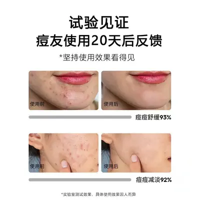 Herbal acne cream with scar fading formula