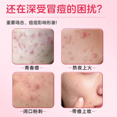 Tuneng Ultra-Thin Star-Shaped Acne Patch, Exudate-Absorbing Wound Dressing - 2