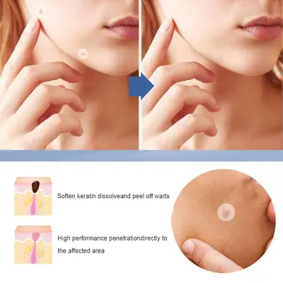 QINGPU Invisible Pimple Patch, Scar and Wart Cover, Makeup Compatible - 4