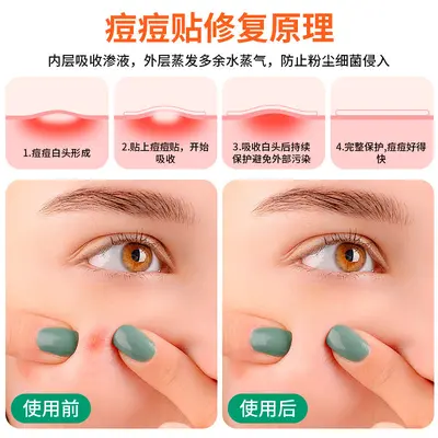 可定制水胶体痘痘贴彩色星星痘痘贴隔离污染便携可爱40粒