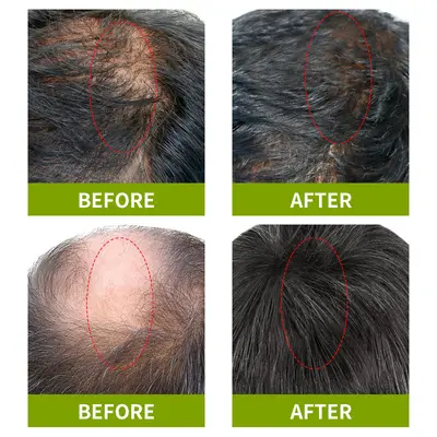 Rosmarin-Haarpflegeöl – natürlich, Haarwuchs und Kopfhautpflege