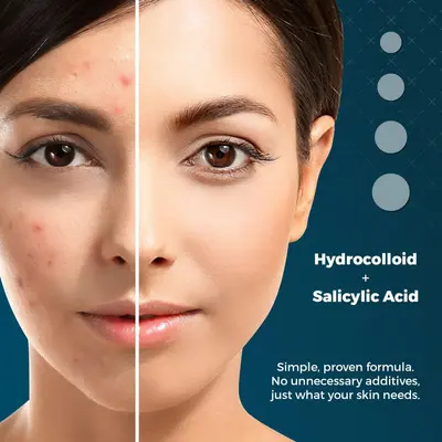 Hydrocolloid acne patches, 360 pieces