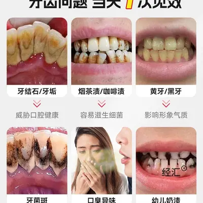 超声波洁牙器牙结石去除器冲牙清洁牙齿结石污垢洗牙家用神器