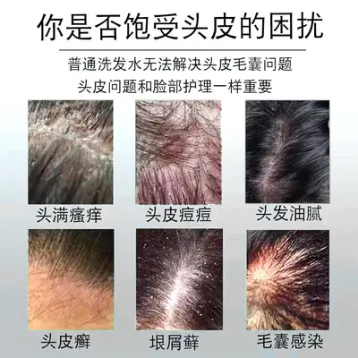 【48小时内发货】芙诗婷煤焦油清洗剂洗发液抑菌液去屑止痒洗发水 - 3