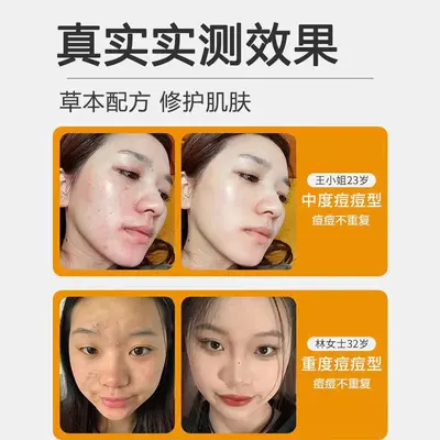 Herbal acne cream with scar fading formula