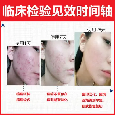 Acne-clearing essence for fading marks and pore refinement
