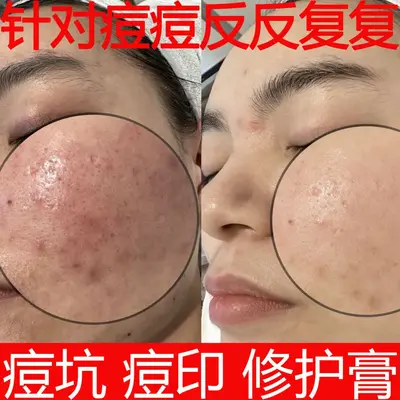 Herbal acne cream with scar fading formula