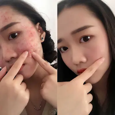 Herbal Acne Treatment, Reduces Acne Marks and Blackheads, for Men and Women - 3