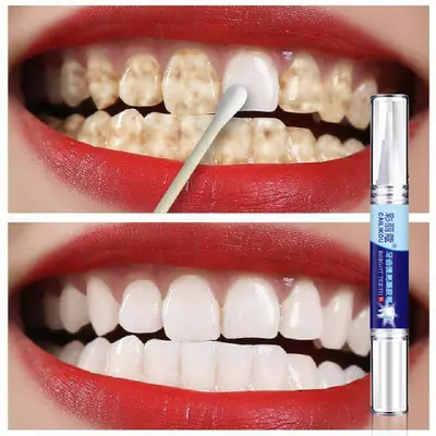 Fast Teeth Whitening Pen for Yellow Teeth, Smoke and Tea Stains