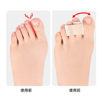 Day and Night Hallux Valgus Toe Separator - 2