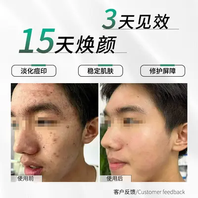Plant Extract Acne Toner for Blackheads and Acne Marks