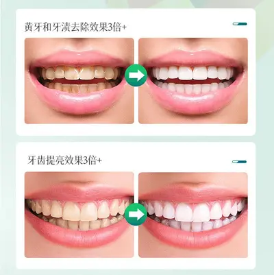 Teeth Whitening Strips for Yellowing and Coffee Stains - 5