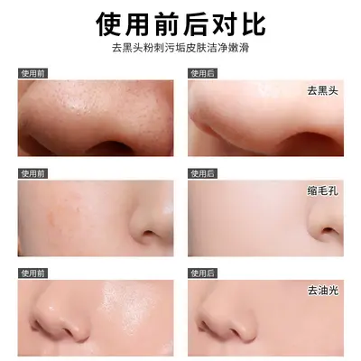 Jinya Blackhead Suction Nose Mask, Pore Shrinking