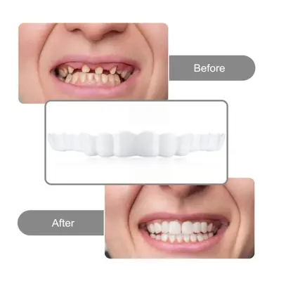 Realistic Upper and Lower Dental Veneers, Gen 2 Temporary Smile Covers - 5