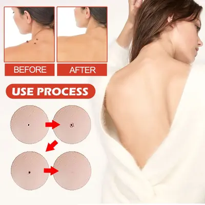 OUHOE Acne Patch, Daily Care, Breathable and Skin-Friendly - 4